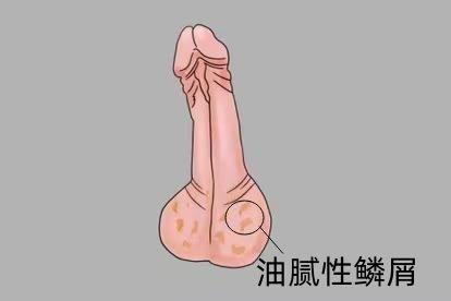 脂溢性皮炎图