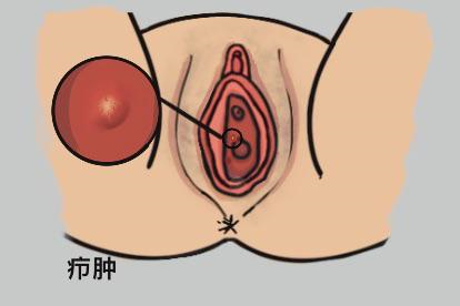 阴道口长了个疙瘩疖肿原因