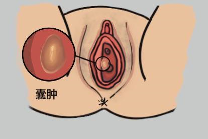 前庭大腺囊肿图
