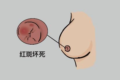 梅毒初期女性乳头硬下疳图