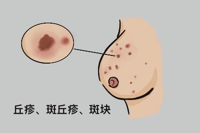 梅毒初期女性乳头梅毒疹图