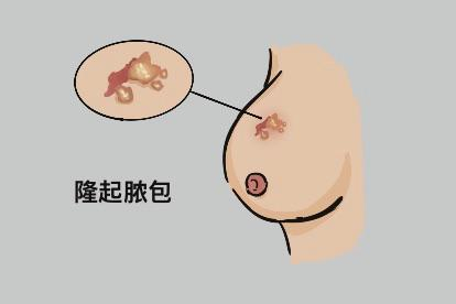 梅毒初期女性乳头脓包图