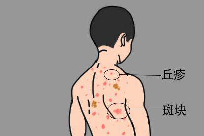 男性感染梅毒后梅毒疹图