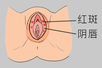 红斑图