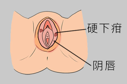硬下疳图