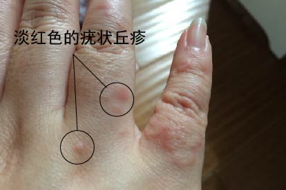 早期手上尖锐湿疣图片