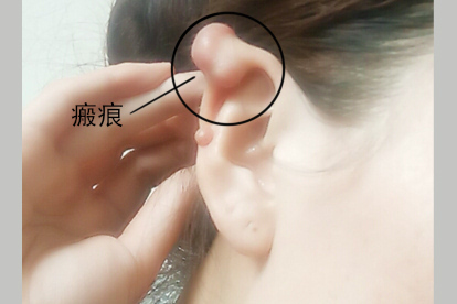 耳朵软骨上有瘢痕图片