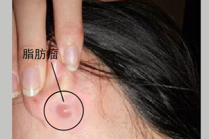 耳朵软骨上有脂肪瘤图片