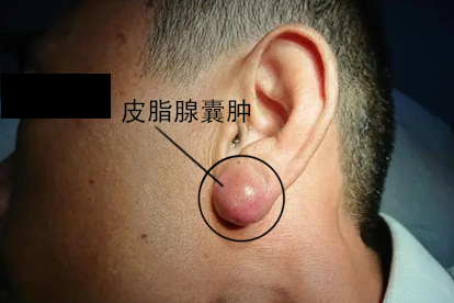 耳朵软骨上有皮脂腺囊肿图片