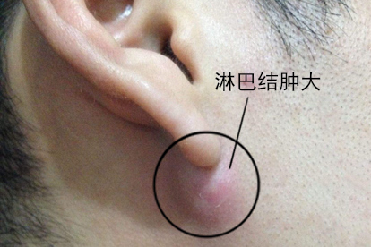 耳朵软骨上有淋巴结肿大图片
