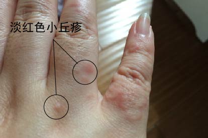 尖锐湿疣早期图片