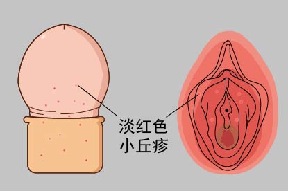 生殖器附近尖锐湿疣早期图片