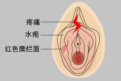 女性生殖器疱疹溃烂图片