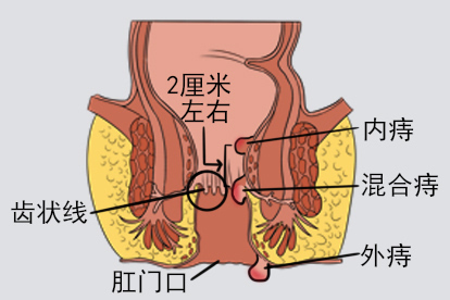 痔长在哪里图片