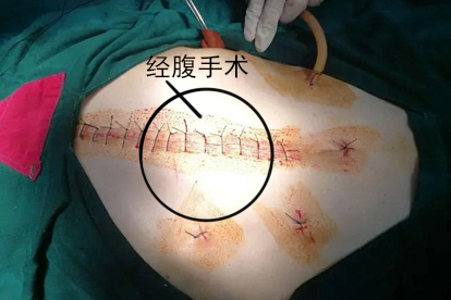 内痔手术治疗图片