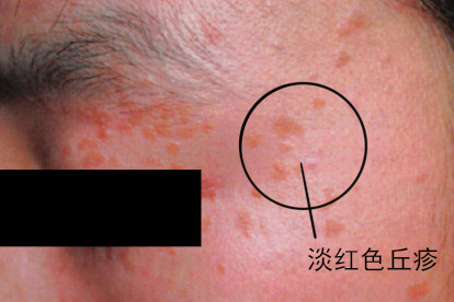 脸上长尖锐湿疣初期图片