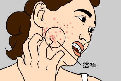 脸上长尖锐湿疣初期瘙痒症状图