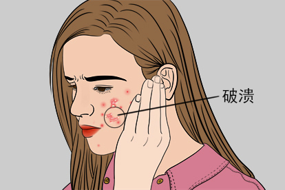 脸上长尖锐湿疣初期破溃症状图