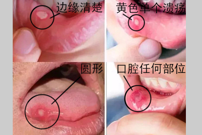 梅毒口腔溃疡的特点图片