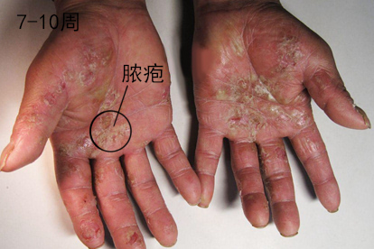 梅毒斑块的发展过程图片