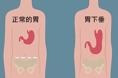 胃下垂表现图
