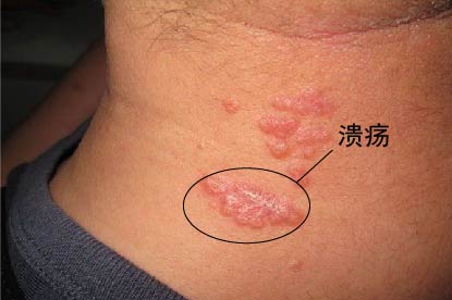 脖子尖锐湿疣症状图