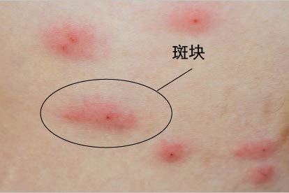 女性梅毒疹症状图片