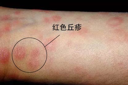 女性梅毒疹症状图片