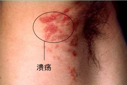 女性梅毒疹症状图片