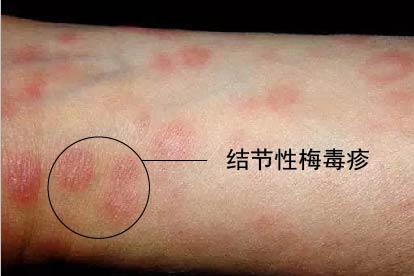 梅毒症状图片