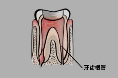 牙齿根管图片