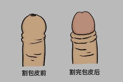 割完包皮好了的图片