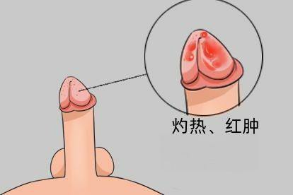 男性淋病初期图片