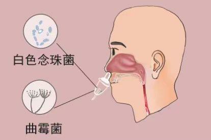 鼻子吸出真菌图片