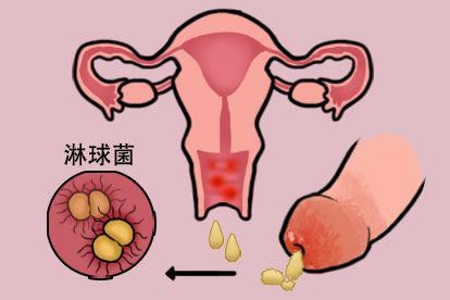 淋病黄色分泌物图片