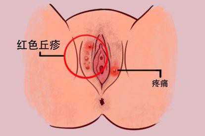 女性性病早期阴唇现象图片