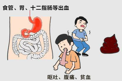 黑便颜色和病因图片