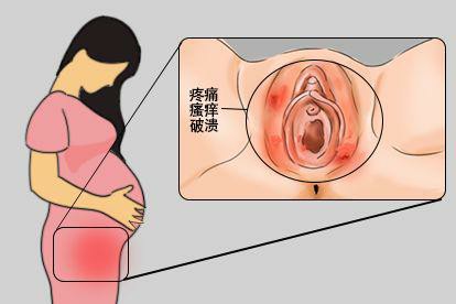 孕期尖锐湿疣症状图片