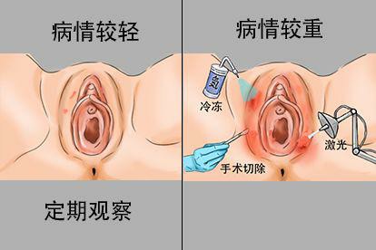 孕期尖锐湿疣治疗图