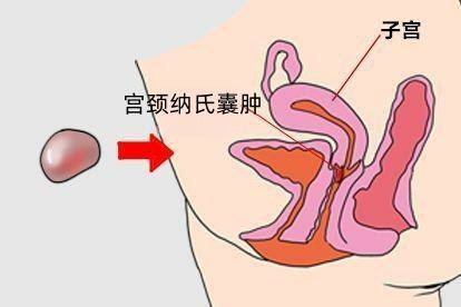 宫颈掉出来的囊泡图片