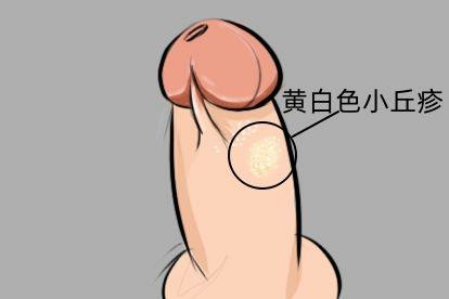 男性生殖器皮脂腺异位症图片