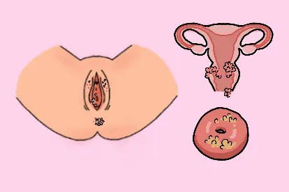 女性生殖器尖锐湿疣症状部位图