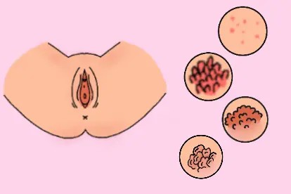 女性生殖器尖锐湿疣症状图