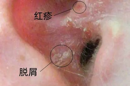 耳朵部位出现疥疮图片