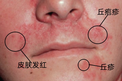 热疹症状图片
