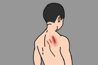男人后背被指甲抓伤的图片