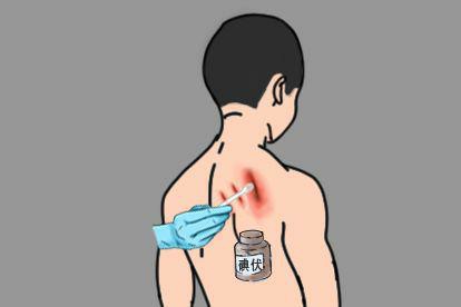 男人后背被指甲抓伤一般处理图