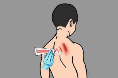 男人后背被指甲抓伤药物治疗图