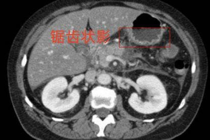 胃ct不正常的图片