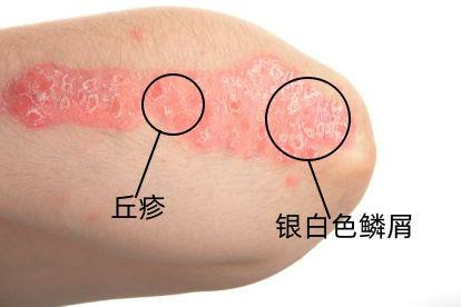 银屑病图片